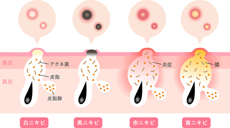 ニキビの種類ごとの症状