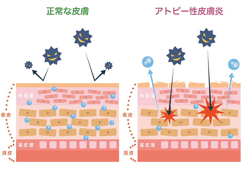 アトピー性皮膚炎の原因