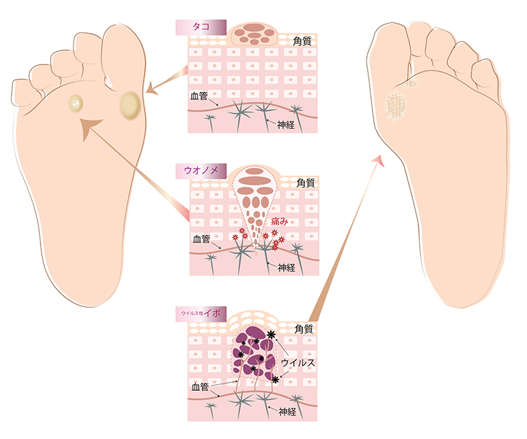 足の裏の「タコ（胼胝）」「魚の目（鶏眼）」とは