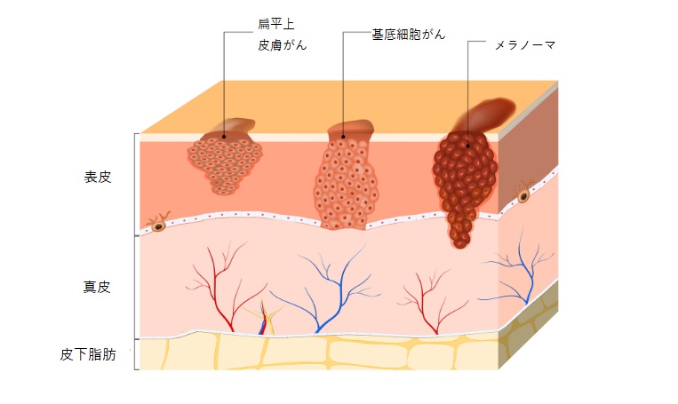 悪性のほくろ（悪性黒色腫）