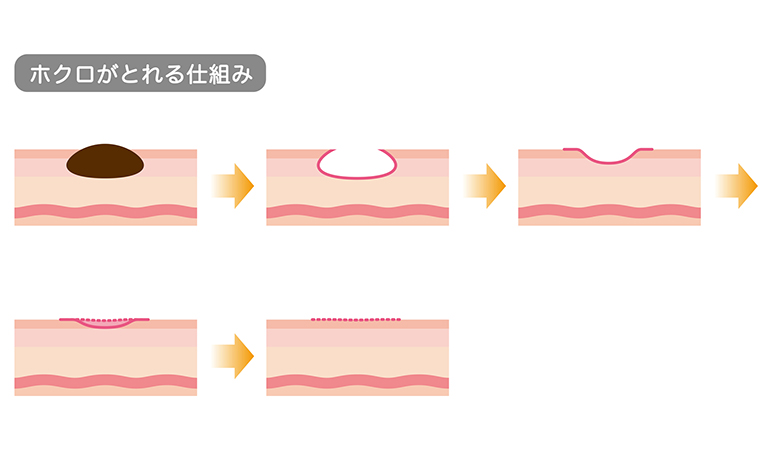 皮膚科で行うほくろ除去（ほくろ取り）