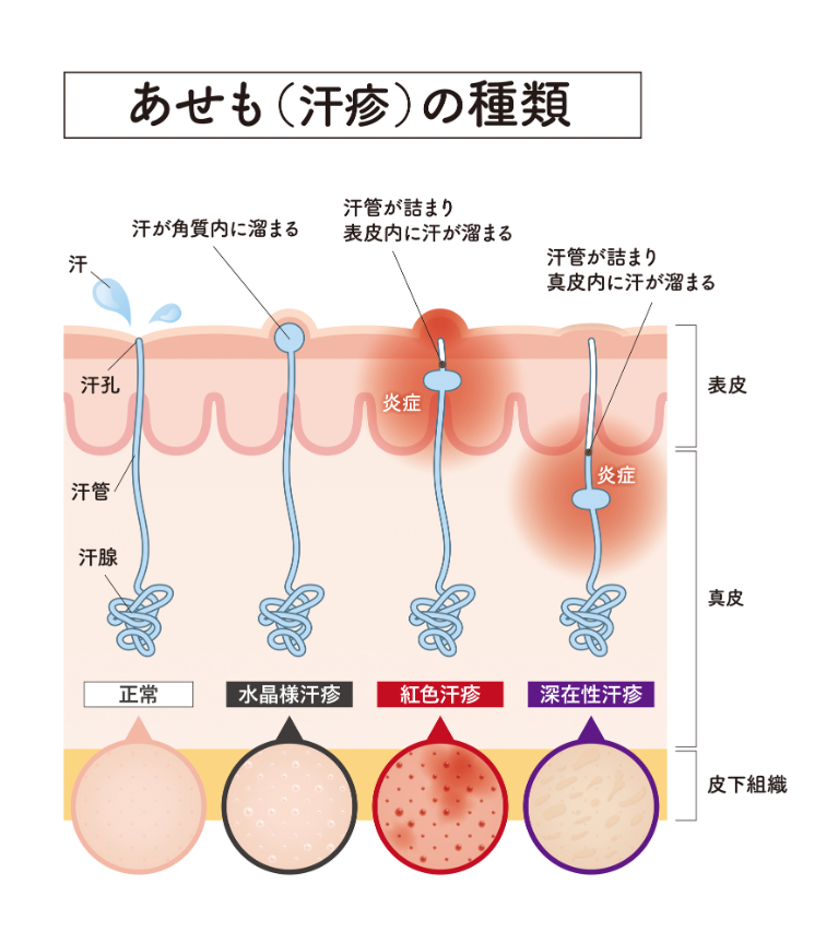 あせもの種類