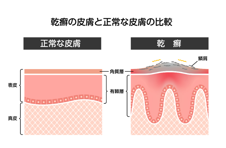 乾癬とは